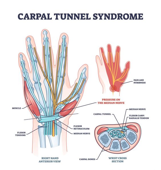 Carpal Tunnel Syndrome: Symptoms, Causes and Treatment